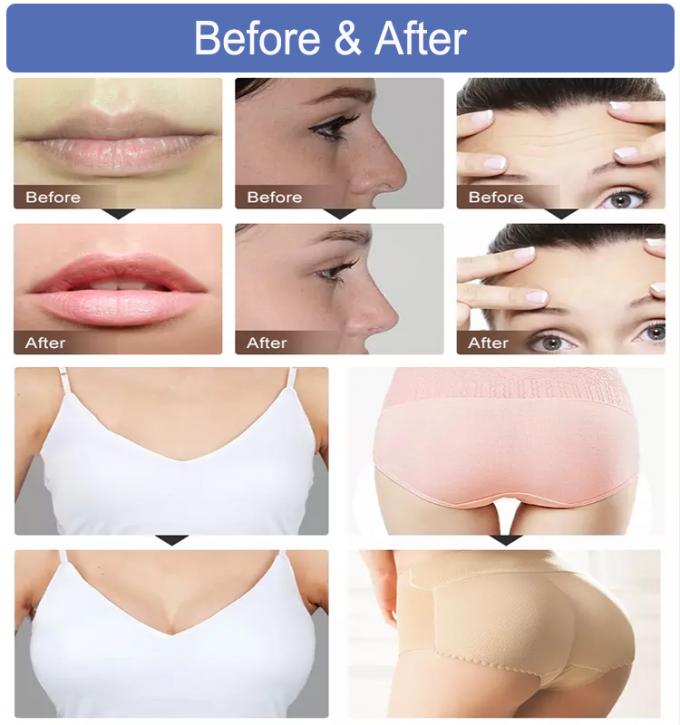 임시 표피 효과 피부 충전물 벌금 Derm 비 외과 입술 충전물